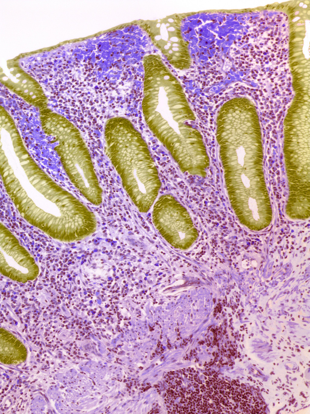 Tarm hos en person med Crohns sykdom, med s&aring;rdanning (gr&oslash;nt) og granulomer (nederst til h&oslash;yre). Illustrasjonsfoto: Science&hellip;