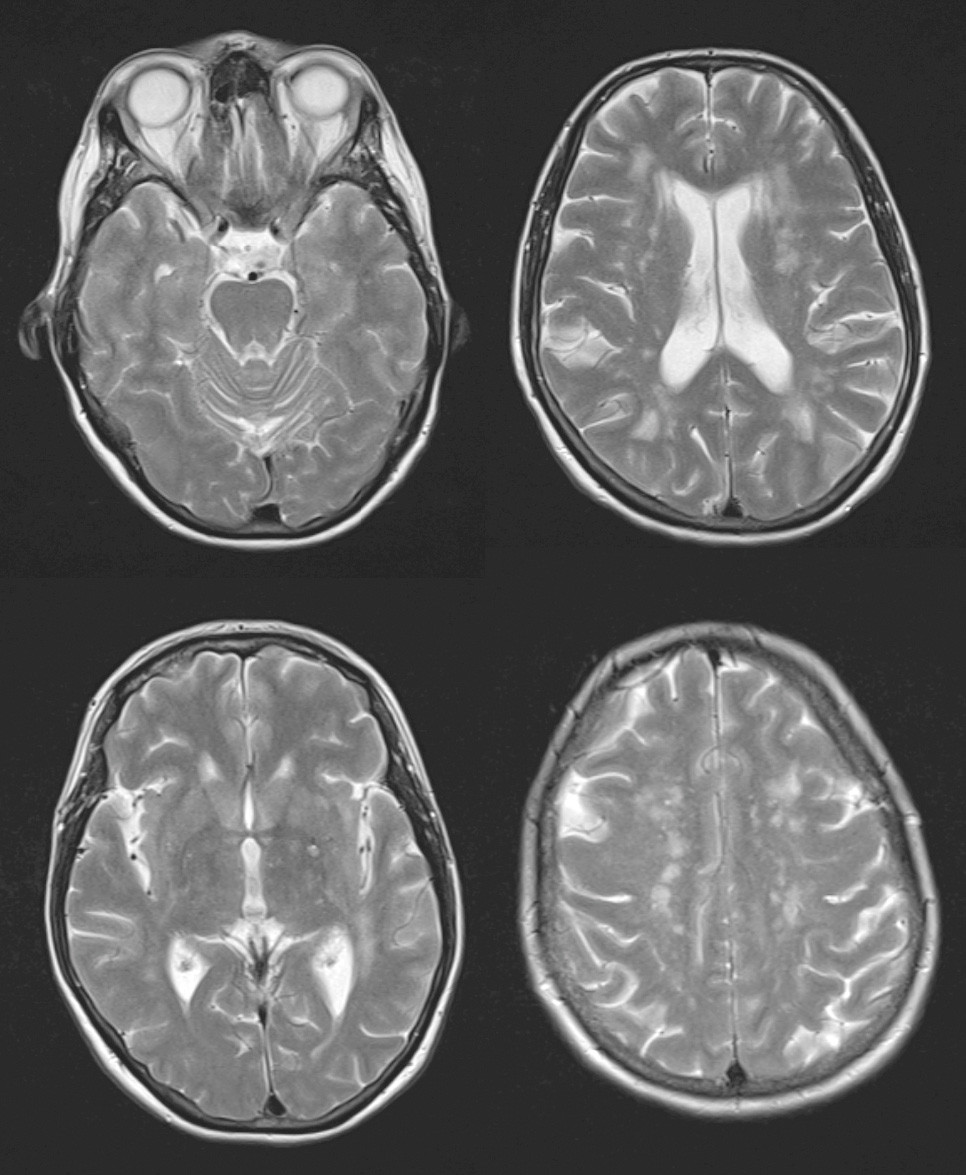 Figure 2 Axial T2-weighted images show multiple, in part confluent, non-specific white matter lesions periventricularly and&hellip;