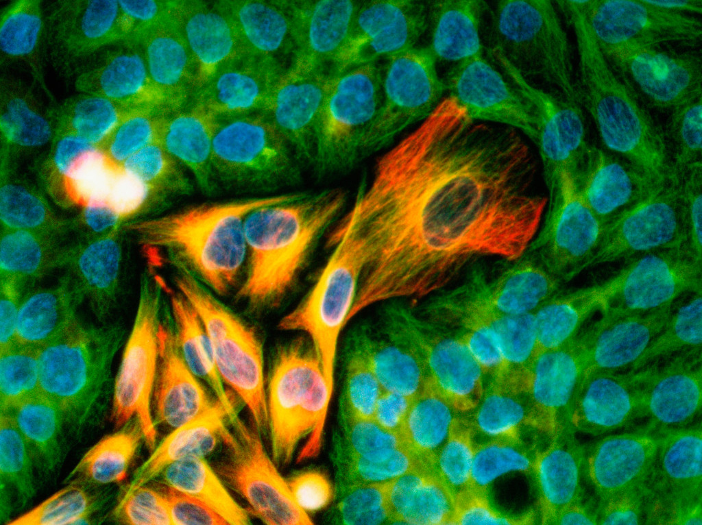 Melanomkreftcelle ved immunflourescens. Illustrasjonsfoto: Science Photo Library/NTB scanpix