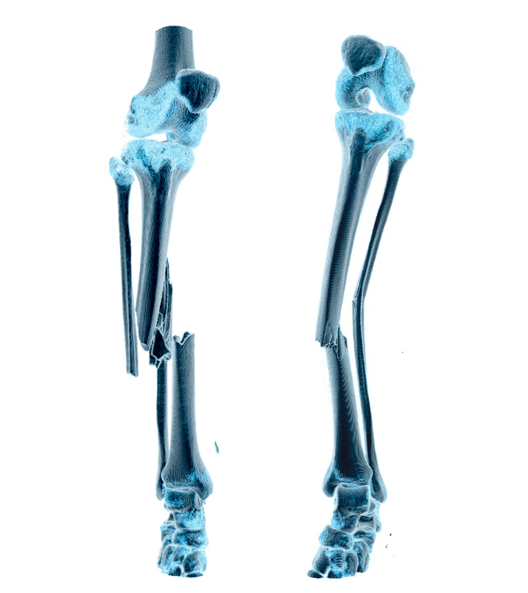 Figure 1 CT images with three-dimensional presentation of left (shown to the right) and right tibia (shown to the left)&hellip;