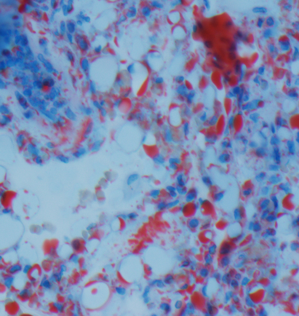 Figure 2 Histopathological section of lung tissue stained with oil red O. Fat is seen as half-moons and globules, which&hellip;