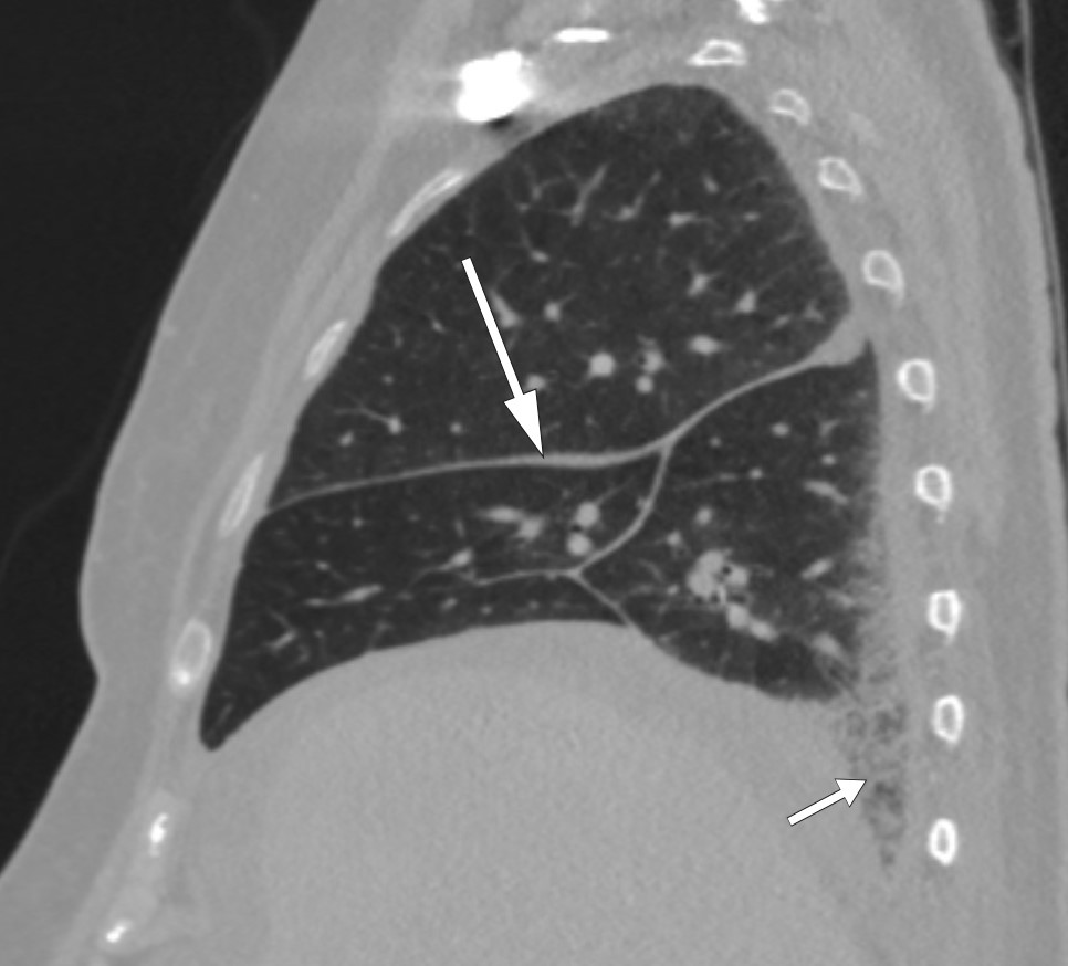 Figure 2 CT thorax showing even thickening of interlobular columns (long arrow) and reticular changes basally in the&hellip;