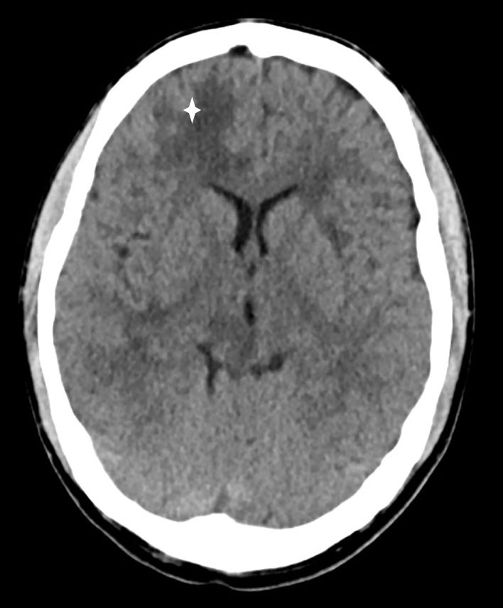 Figure 1 CT head without contrast medium showing low-attenuation changes in frontal white matter in the right cerebral&hellip;