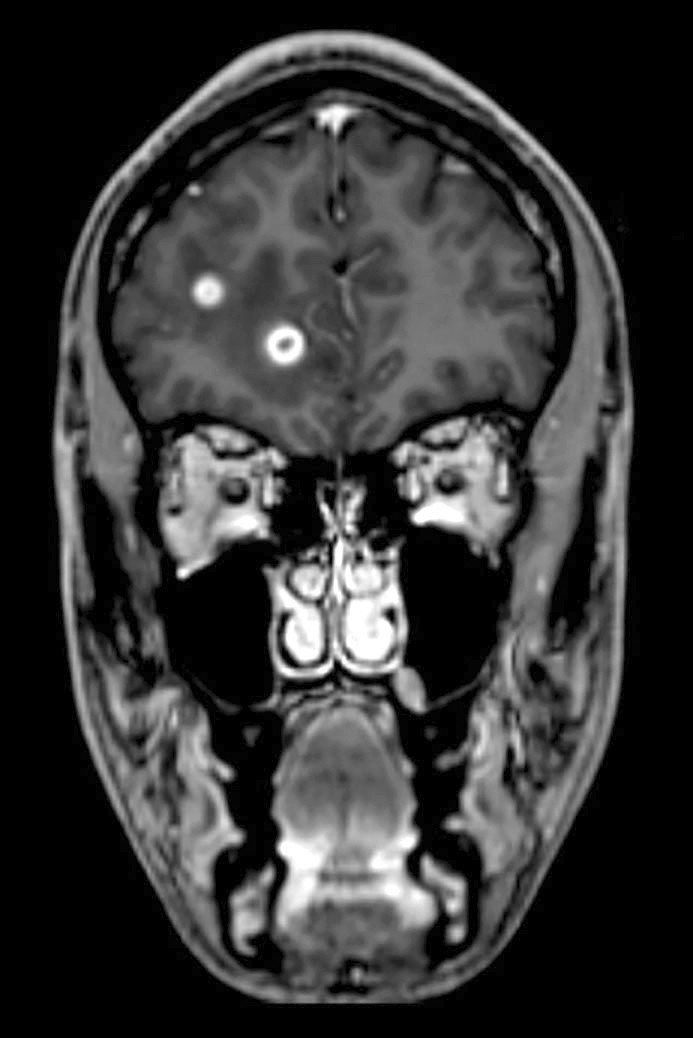 Figure 2 T1-weighted volumetric magnetic resonance tomography of brain and medulla, taken with contrast medium. The image&hellip;