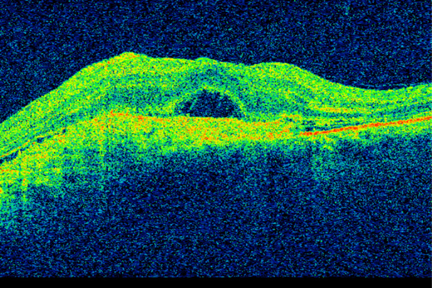 Figure 2 OCT of the macula in a patient with wet age-related macular degeneration prior to initiation of anti-VEGF treatment&hellip;