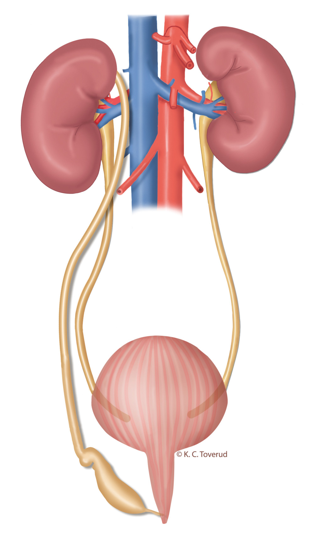 Figure 3 Illustration of a right-sided duplex collecting system. The ureter from the upper collecting system is dilated, but&hellip;