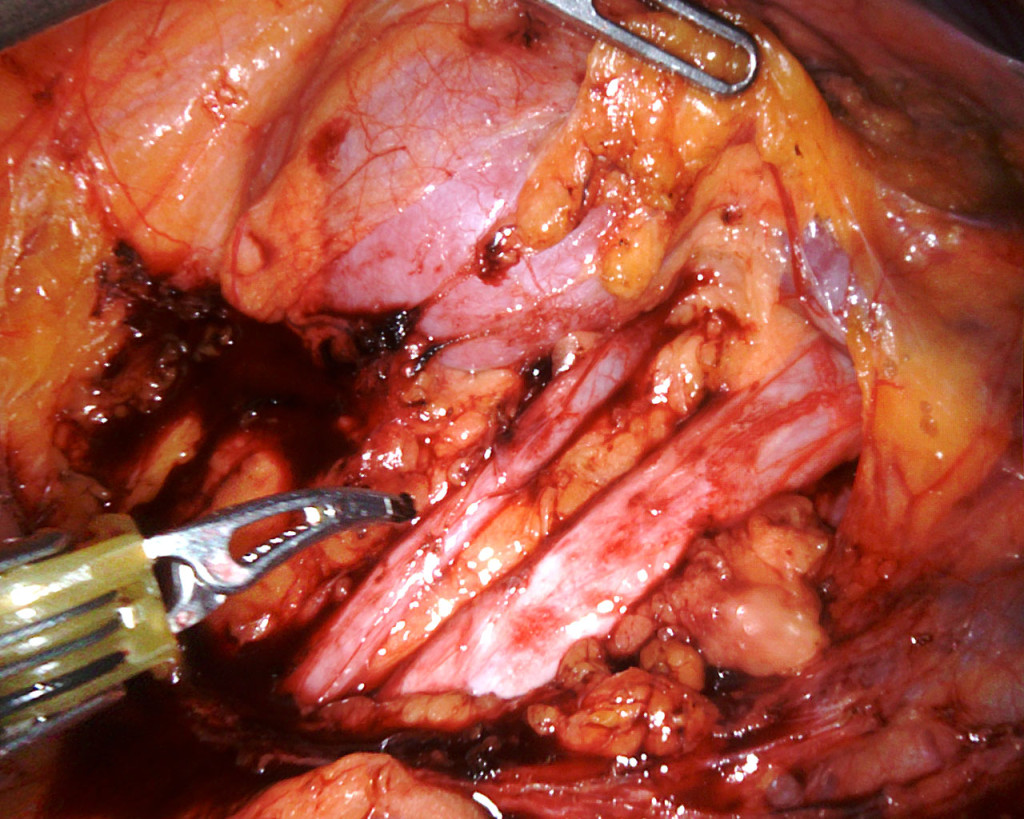 Figure 4 The normal narrow ureter and the ectopic dilated ureter as seen during surgery.