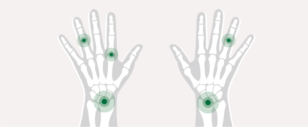 Figur 1 N = 5 eller N = 1? M&aring;linger fra ulike ledd med artritt hos &eacute;n og samme pasient kan v&aelig;re korrelert, noe som m&aring; tas&hellip;