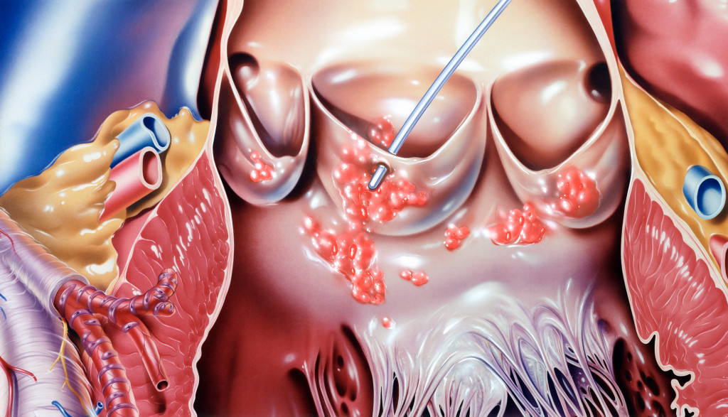 Infeksi&oslash;s endokarditt i aortaklaffen. Her ses perforasjon av en kusp (indikert med disseksjonsverkt&oslash;y). En bakteriell&hellip;