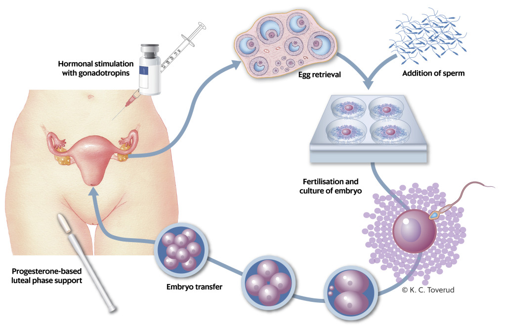 Figure 1 Fertility treatment with in vitro fertilisation.