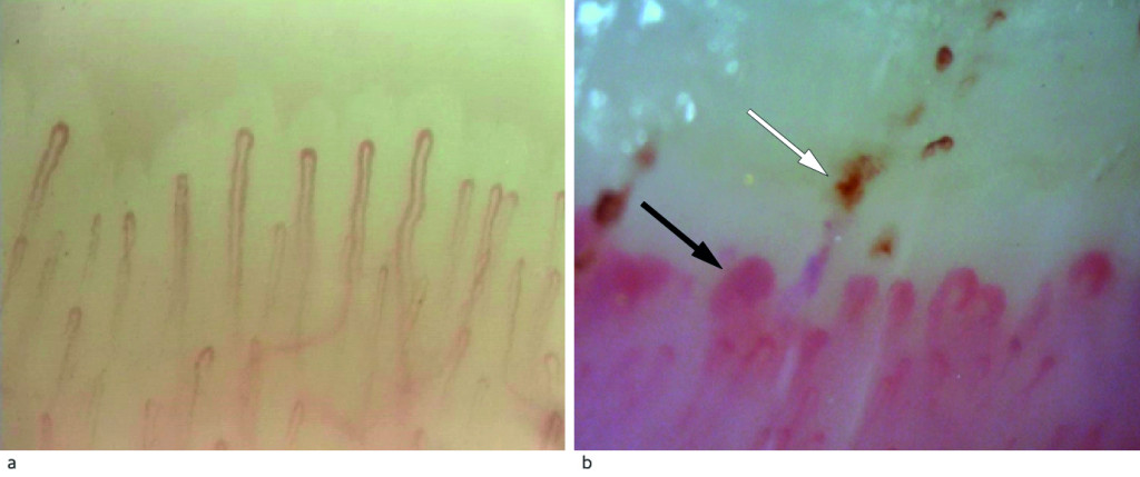 Figure 2 a) Nailfold capillaroscopy in a healthy person with normal capillary density and architecture. B) Capillaroscopy of&hellip;