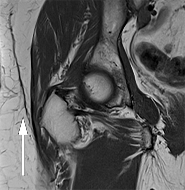 Figure 2 Coronal T1-weighted MRI of right hip. Minor residual changes after previous fluid-filled locule.