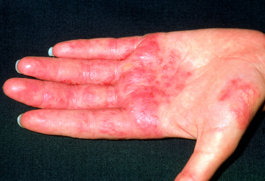Figure 2 Contact eczema in a hairdresser. The skin is flaky and itchy and the upper layers are peeling away. The rash is&hellip;