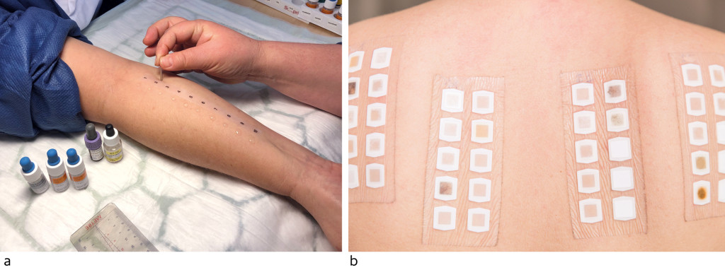 Figure 3 a) Skin prick testing. Photo: Regional Centre for Asthma, Allergy and Hypersensitivity, Oslo University Hospital. b&hellip;