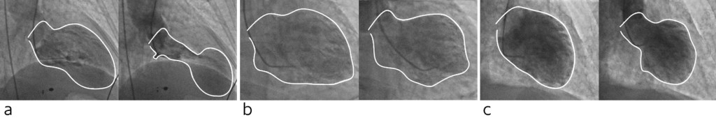 Figure 2 a) Apical type Takotsubo syndrome. Outline of the left ventricle in end diastole and end systole. b) Mid&hellip;