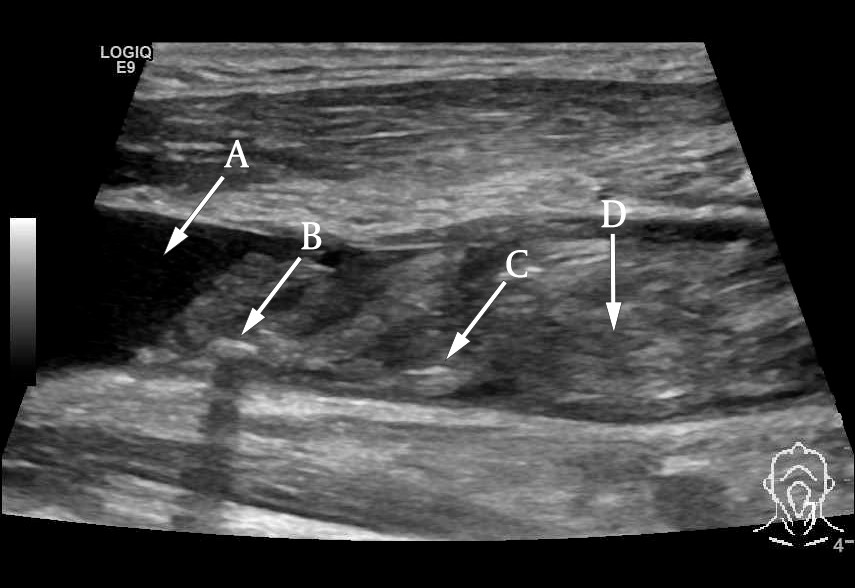 Figure 1 Ultrasound visualisation of an almost totally occlusive thrombus in the left internal jugular vein, longitudinal&hellip;