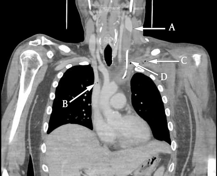 Figure 3 CT venography showing the extent of the thrombotic mass. Arrow A shows the transition between free lumen and&hellip;