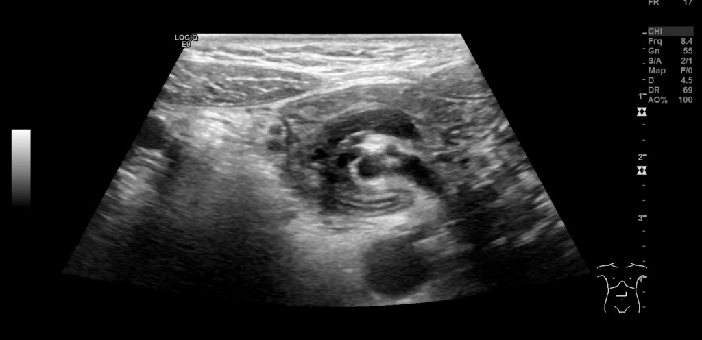 Figure 1 Ultrasound. Whirl sign involving vessels and the small intestine in the epigastrium.