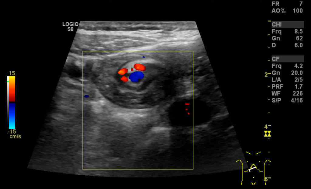 Figure 2 Ultrasound. Whirl sign involving mesenteric vessels and loops of small intestine. The superior mesenteric artery &hellip;