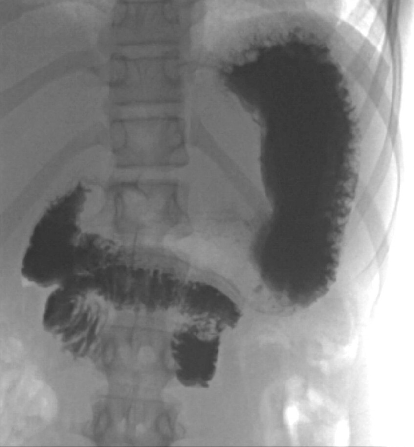 Figure 3 Upper gastrointestinal series (x-ray of oesophagus, stomach and duodenum). Contrast can be seen in the stomach and&hellip;