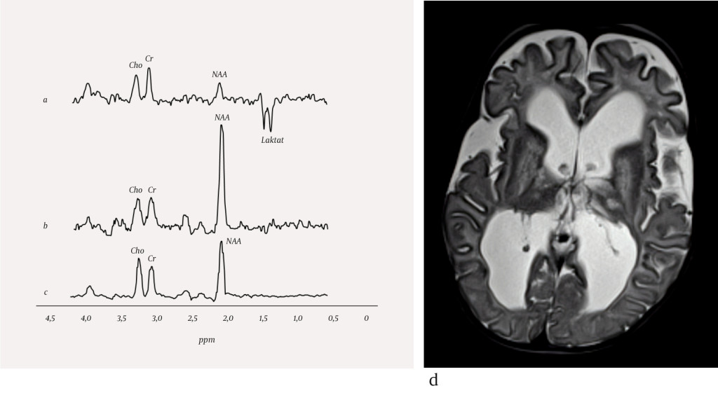 Figure 1 MR spectra from a) a patient with Leigh syndrome, b) a patient with Canavan disease and c) a healthy person, and d)&hellip;