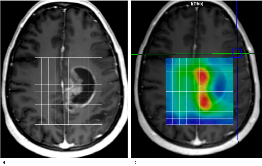 Figure 3 Chemical shift imaging of glioblastoma: a) contrast-enhanced T1-weighted image, showing the volume specified for&hellip;