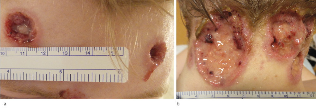 Figure 2 Ulcerations on the forehead (a) and neck (b) following wound care on day 4. The wound edges were moderately&hellip;