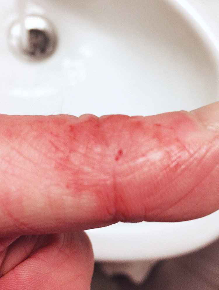 Figure 1 Reaction around the injection site following an accident at work while vaccinating fish.