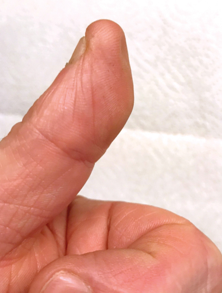Figure 2 Atrophied pulp approx. ten months after self-injection injury in the thumb during vaccination of fish.