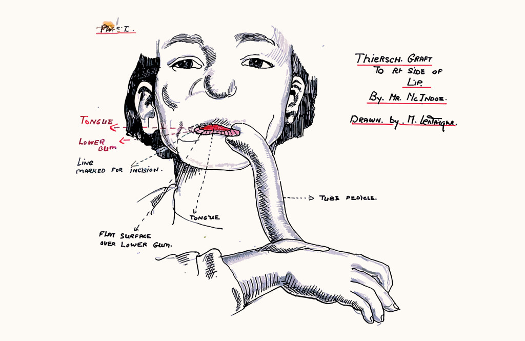 Figur 1 Illustrasjon av en avstandslapp (tube pedicle) tegnet av Mollie Lentaigne &ndash; en ung, britisk kvinne som var ansatt p&aring;&hellip;