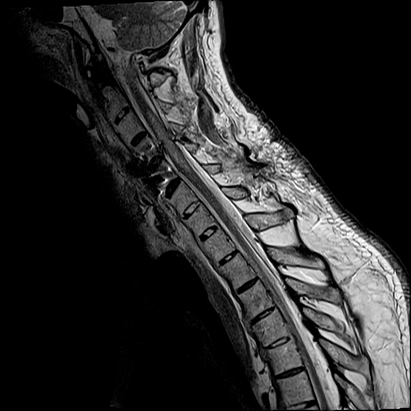 Figure 1 MRI of the cervical spine after surgical fixation at the C4&ndash;C5 level. Centromedullary injury can be seen at levels&hellip;