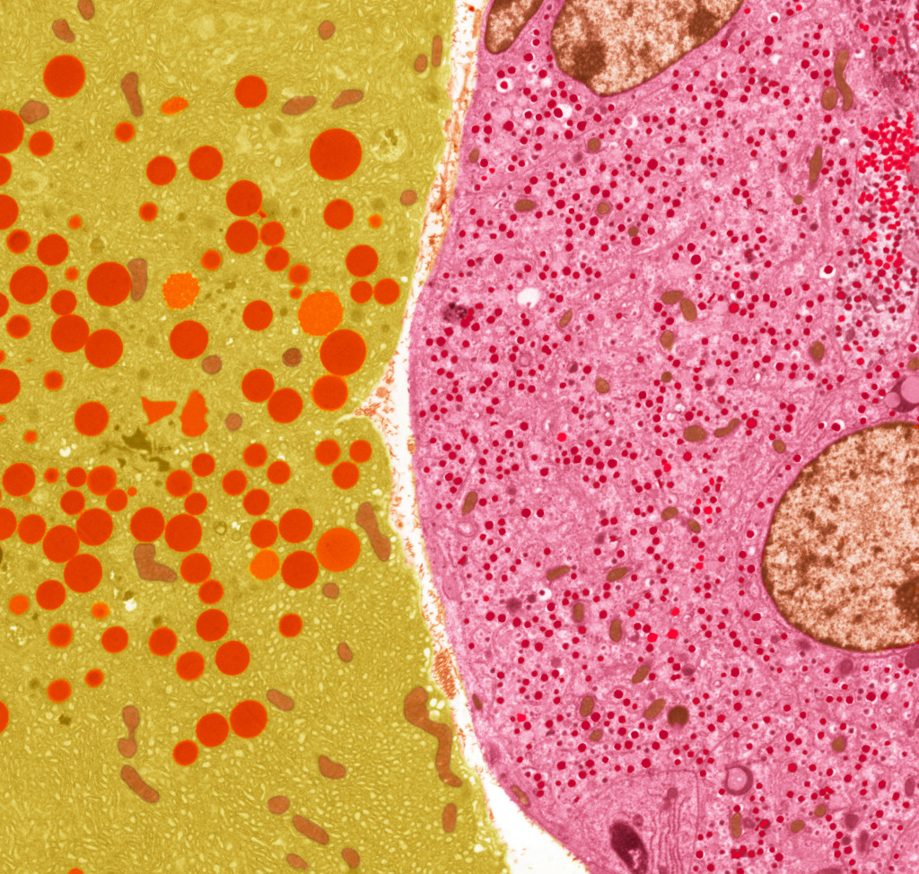 Pancreasceller sett gjennom transmisjonselektronmikroskop: eksokrin celle (gul) og endokrin &oslash;ycelle (rosa)&hellip;