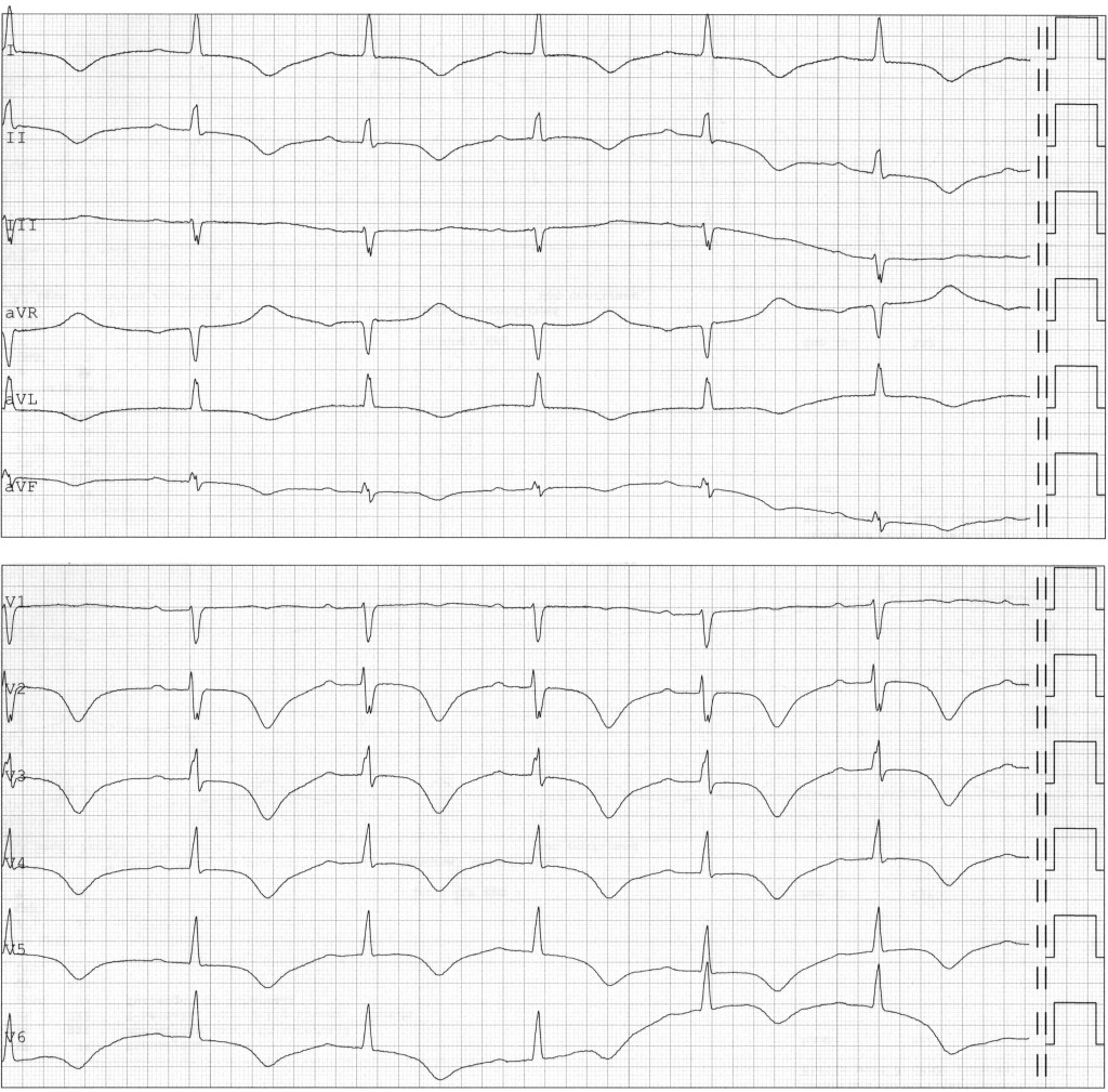 Figure 3 ECG from day 11 showing sinus rhythm but new-onset T-wave inversion in standard leads I, II, avL and aVF and in&hellip;
