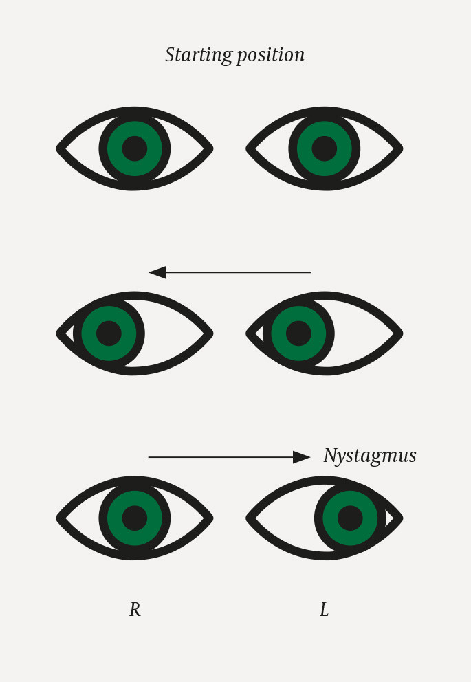 Figure 1 Internuclear ophthalmoplegia