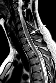 Figure 1 Sagittal T2-weighted MRI showed lesions consistent with myelitis at multiple levels.