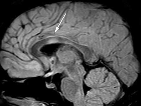Figure 4 Lesion in the corpus callosum on sagittal FLAIR-MRI.