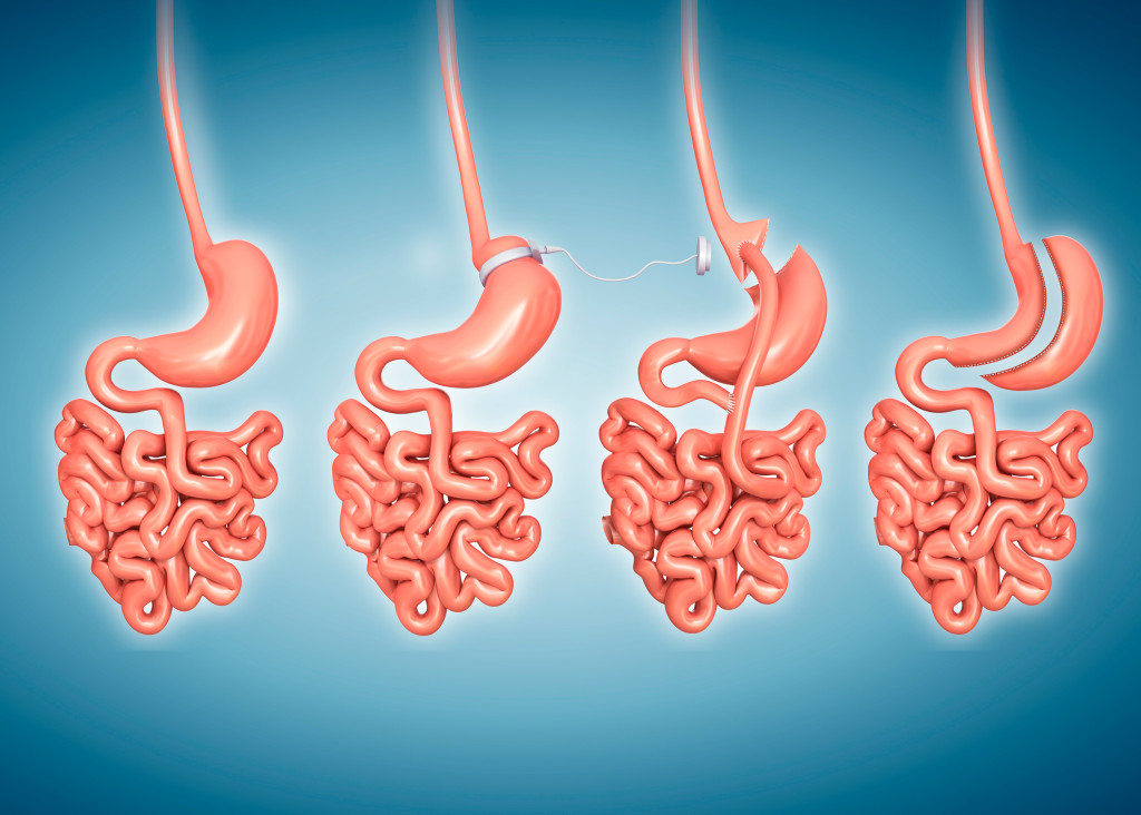 Fra h&oslash;yre til venstre: En vanlig mage, gastrisk innsn&oslash;ring (banding), gastrisk bypass og langsg&aring;ende ventrikkelreseksjon &hellip;