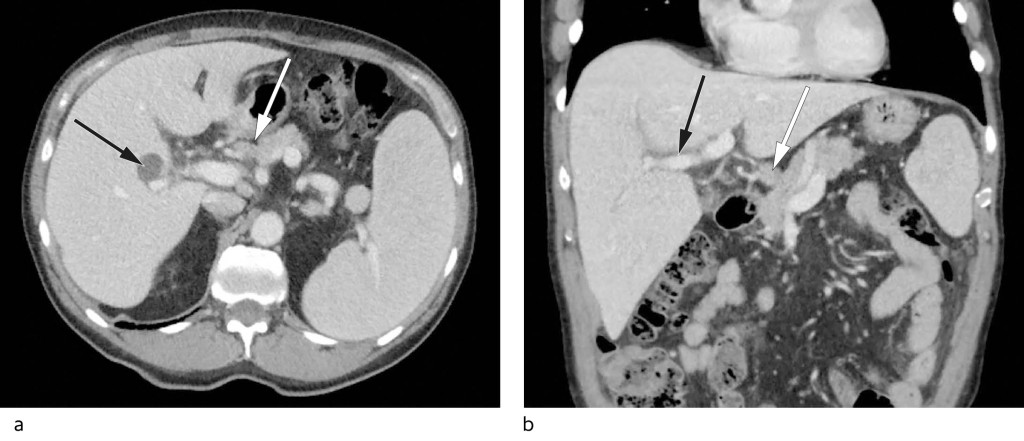 Figure 1 a) Axial CT of the upper abdomen with enlarged spleen and accessory spleen, prominent hepatic hilar lymph glands &hellip;
