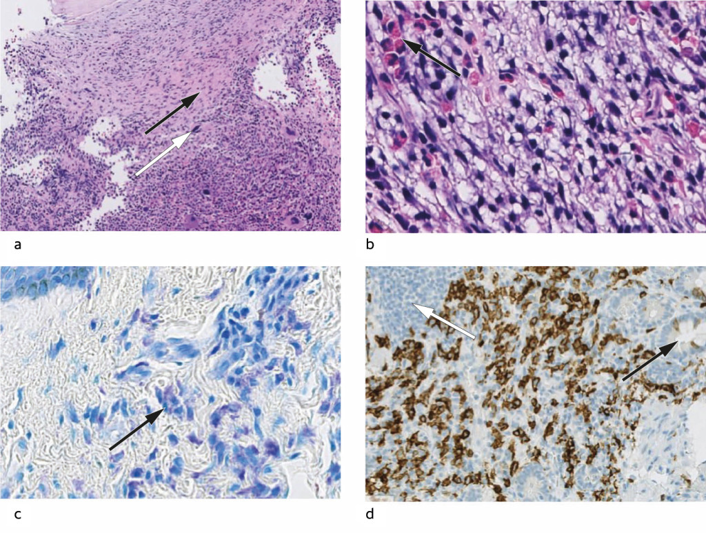 Figure 2 a) Bone marrow biopsy. The marrow is maximally cell rich. In the upper half, infiltrating mast cells can be seen in&hellip;