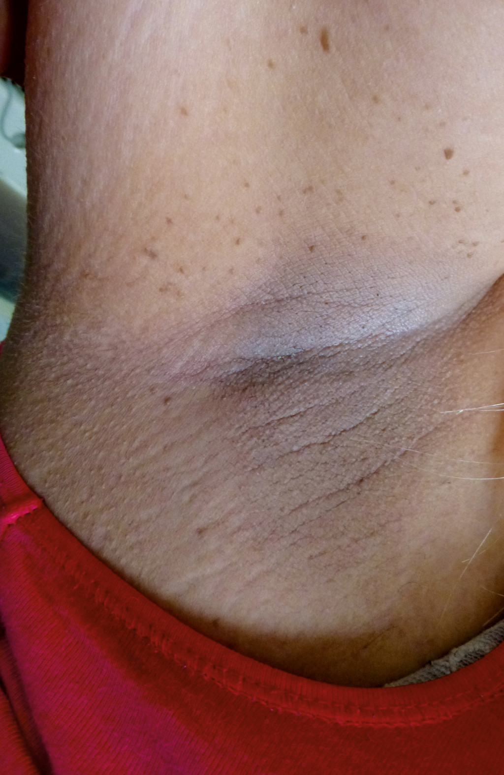 Figure 1 The patient had hyperpigmentation and freckles in her armpits.