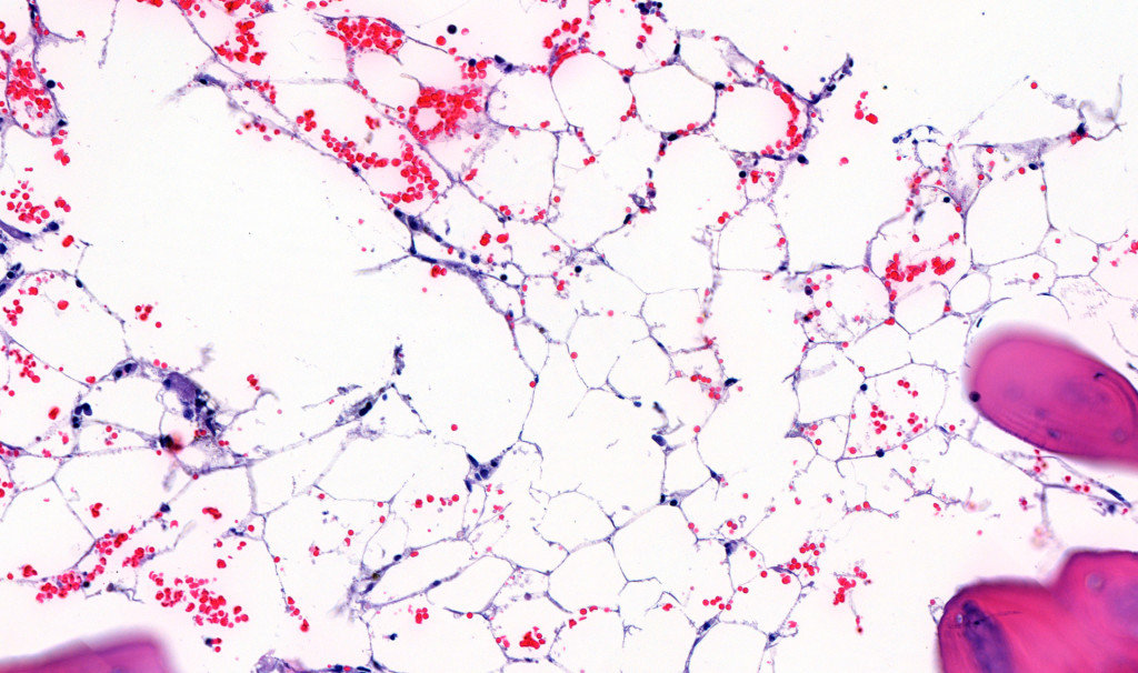 Figure 2 Detailed image of crista biopsy showing acellular area replaced by marrow adipose tissue.