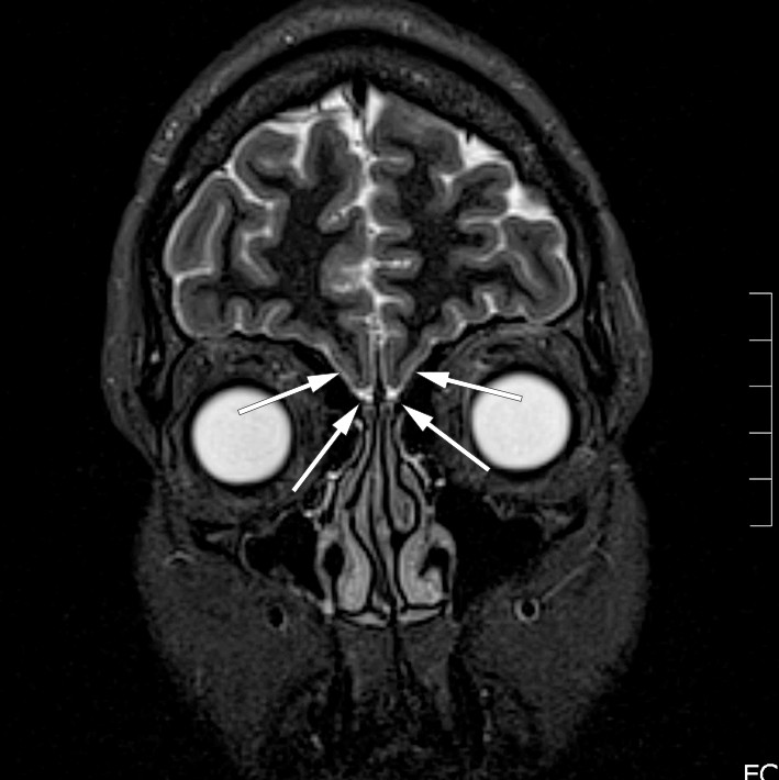 Figure 1 MRI of the head, coronal plane, 2 mm STIR sequence. The arrows show the absence of the olfactory sulcus and&hellip;