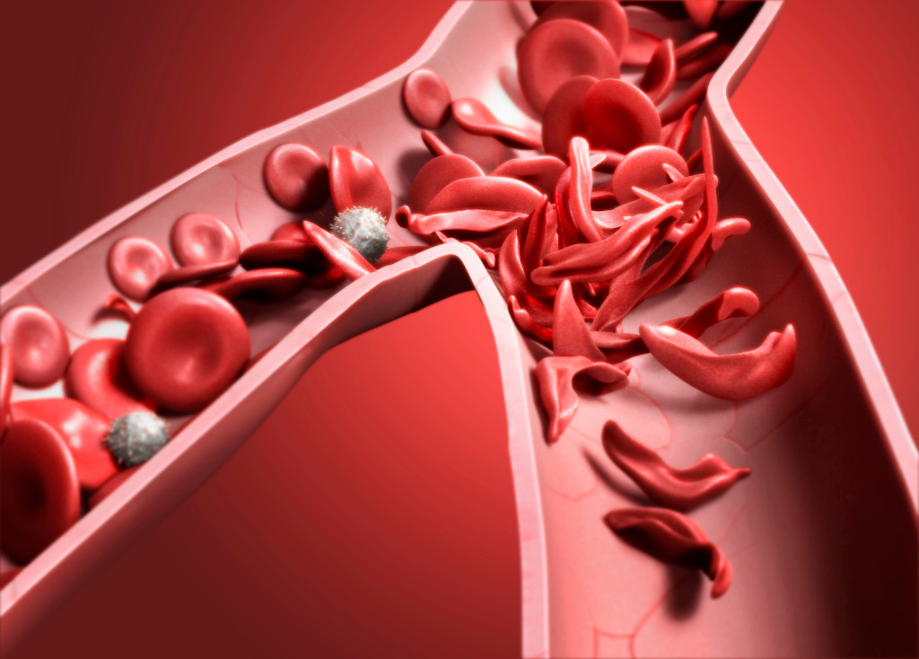 Normale erytrocytter (r&oslash;de skiver) og erytrocytter p&aring;virket av sigdcelleanemi (halvm&aring;neformet). Sigdceller kan ikke bevege&hellip;