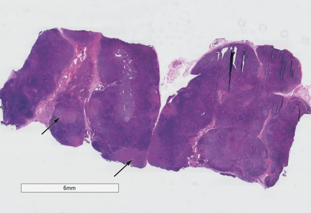 Figure 1 Haematoxylin and eosin-stained section. The arrows point to necrotic areas of the lymph node.