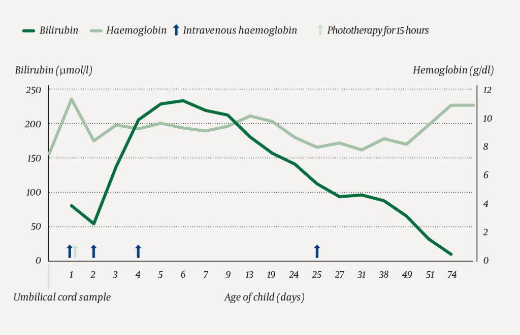 Figure 2 Bilirubin and haemoglobin levels in the neonate. Treatment with intravenous immunoglobulin (first two doses: 0.5 g&hellip;