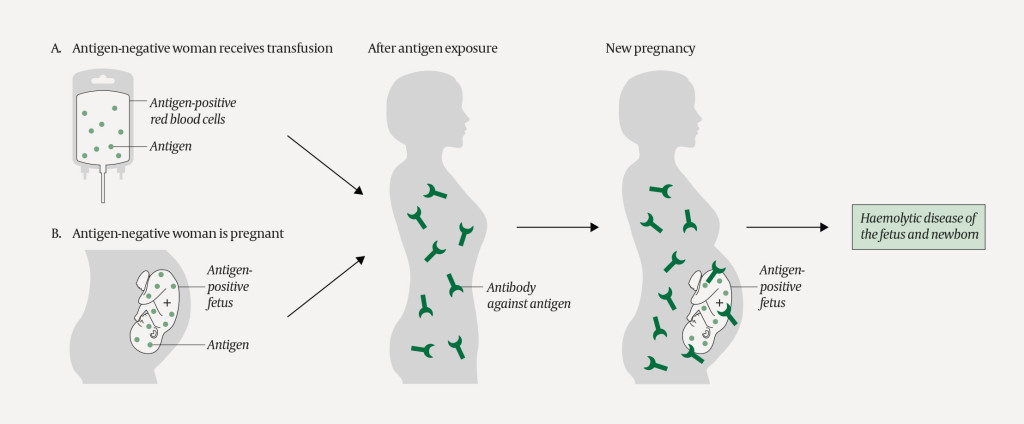 Figure 3 A woman who is exposed to (an) antigen(s) she does not express on her own red cells may form blood group antibodies&hellip;