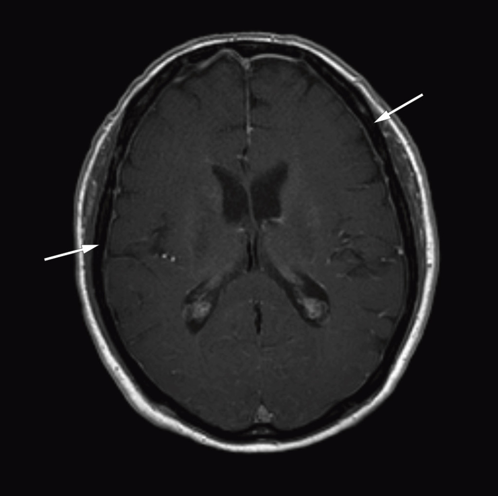Figure 1 Cerebral MRI after injection of contrast medium (axial section) shows thickened and contrast-enhanced meninges over&hellip;