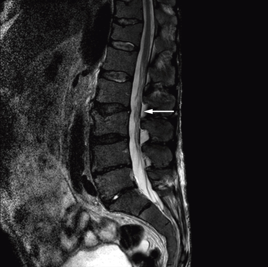 Figure 2 Sagittal T2-weighted MRI image of the lumbosacral column shows wavy, thickened cauda equina roots.