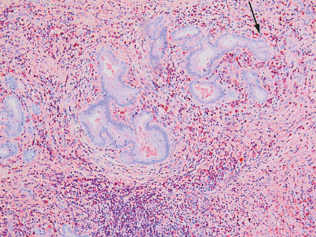 Figure 2 Histological section from liver hilum with lymphoplasmacytic inflammation and abundant eosinophil granulocytes. An&hellip;