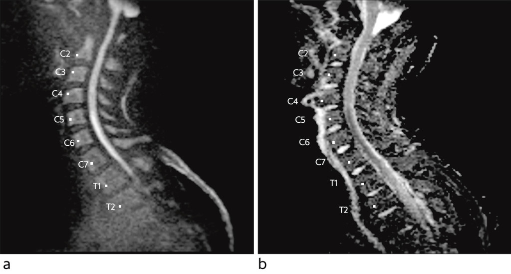 Figure 1 Sagittal diffusion-weighted MRI sequence with b-1 000 image (a) and apparent diffusion coefficient (ADC) map (b)&hellip;